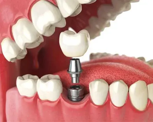 Dental Implants