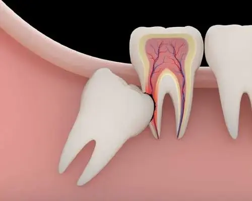 Teeth Extraction